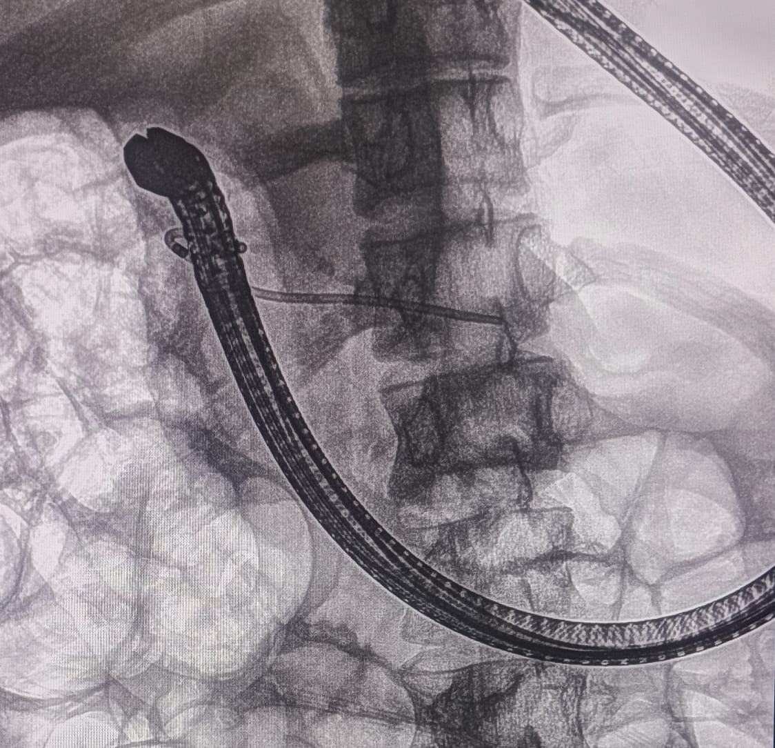 Chronic Pancreatitis ERCP Image 3